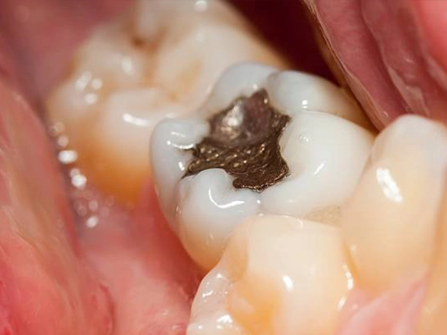 Amalgam Dolgu